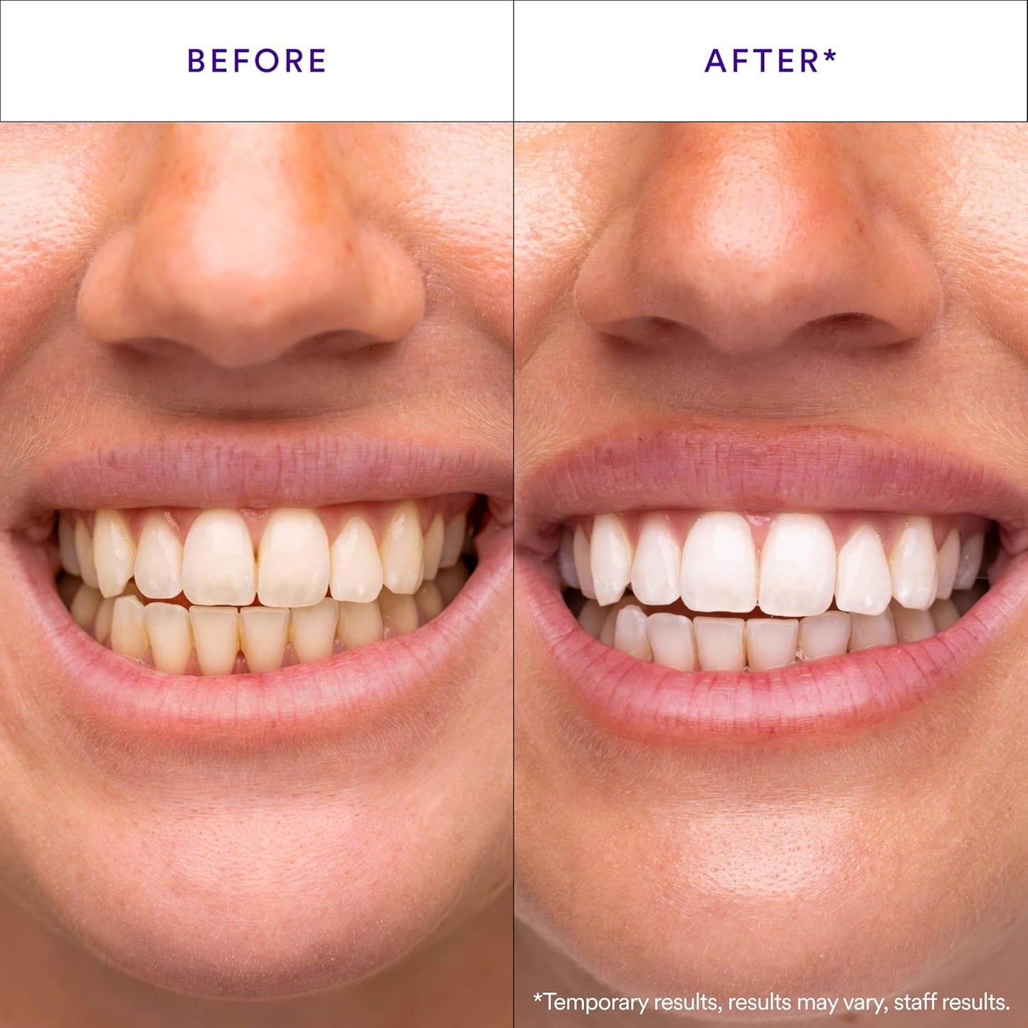 V34 Whitening Strips, Teeth Whitening Strips, Purple Tooth Whitening, Purple Whitening Strips, Tooth Stain Treatment, Combining Whitening and Colour Correction