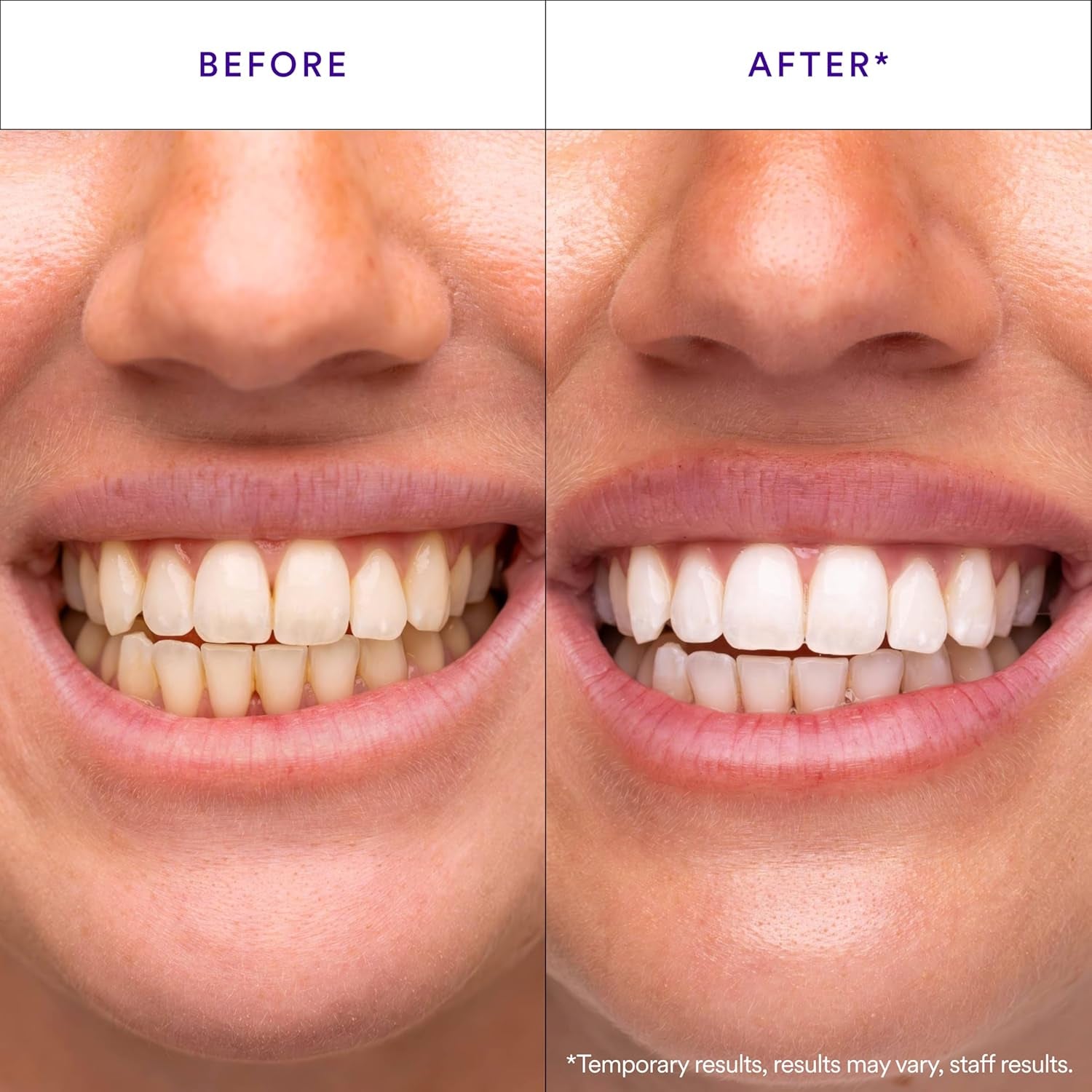 V34 Whitening Strips, Teeth Whitening Strips, Purple Tooth Whitening, Purple Whitening Strips, Tooth Stain Treatment, Combining Whitening and Colour Correction