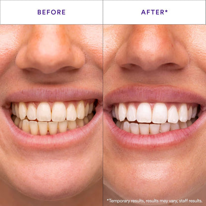 V34 Whitening Strips, Teeth Whitening Strips, Purple Tooth Whitening, Purple Whitening Strips, Tooth Stain Treatment, Combining Whitening and Colour Correction